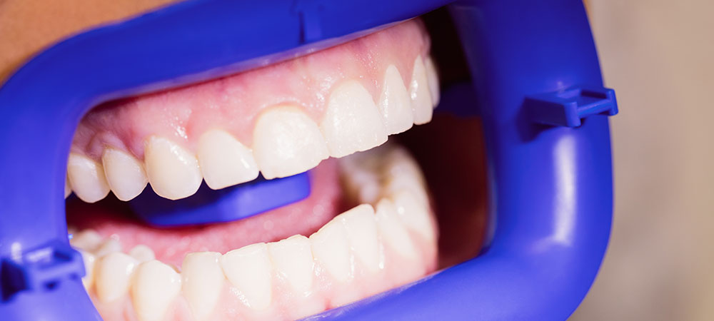 What Is Dental Sedation & How Does It Work?